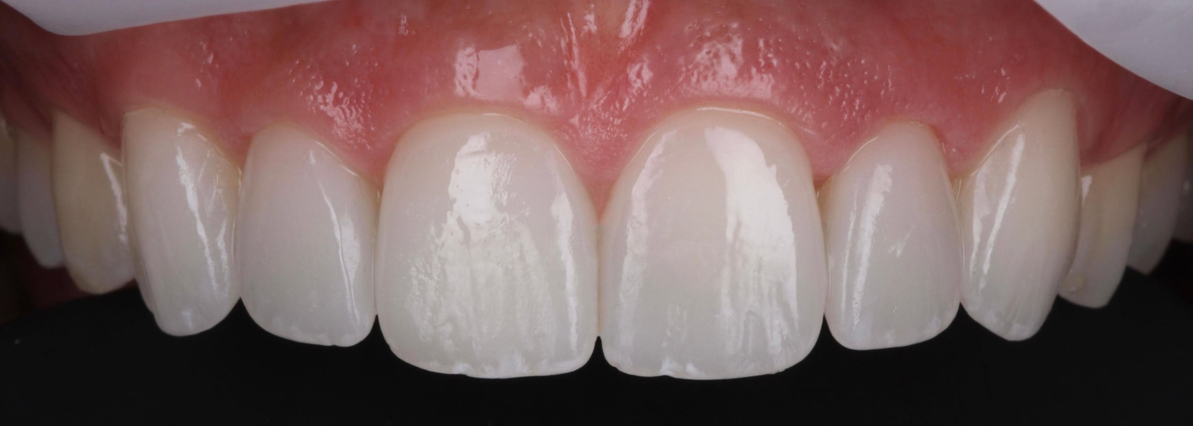 Retracted clinical photograph of the same upper front teeth after porcelain veneer treatment, showing restored edge length, even proportion and a uniform surface.