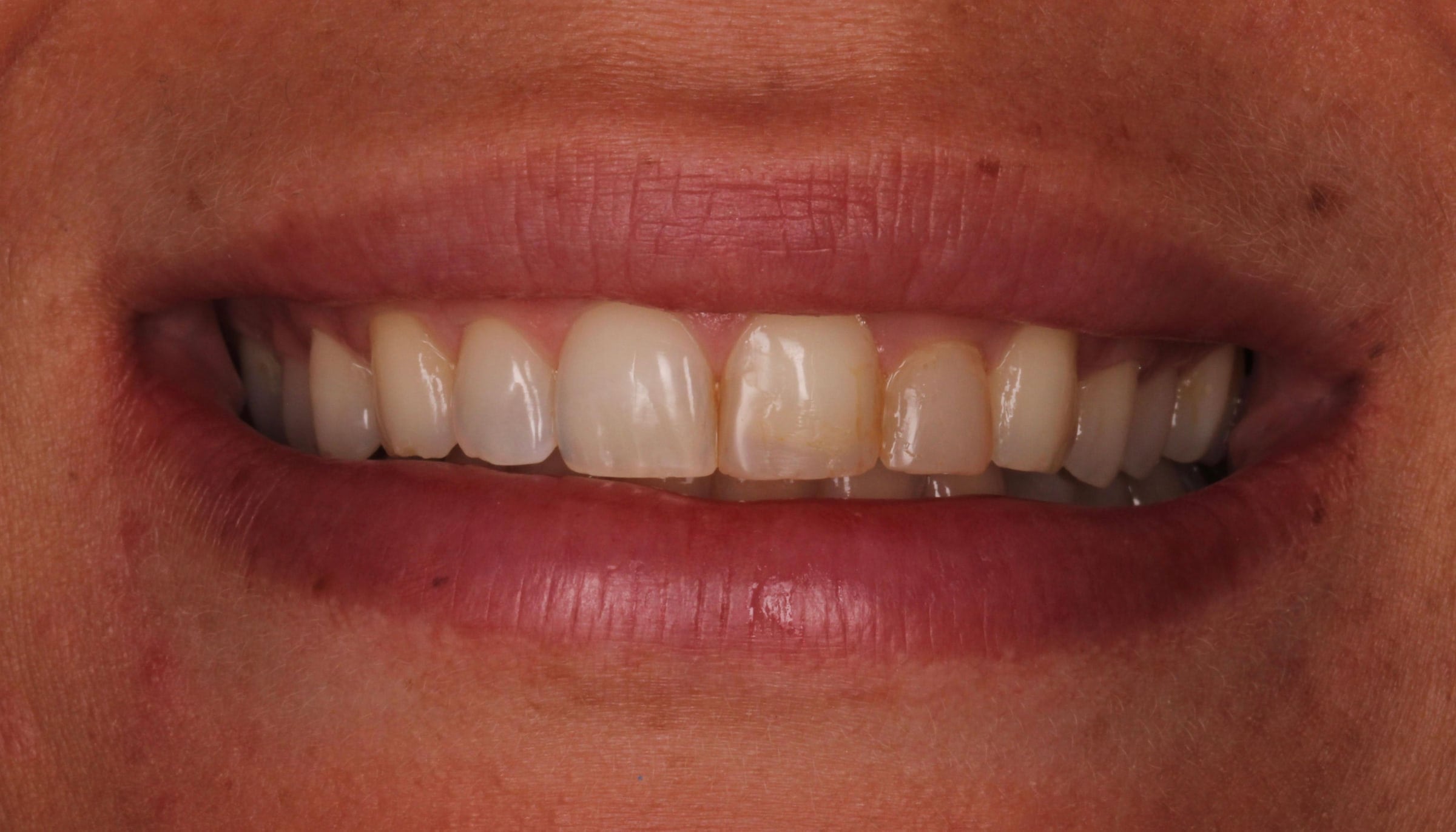 Close-up photograph of the patient's smile before treatment, with shortened, worn and unevenly shaded upper teeth.